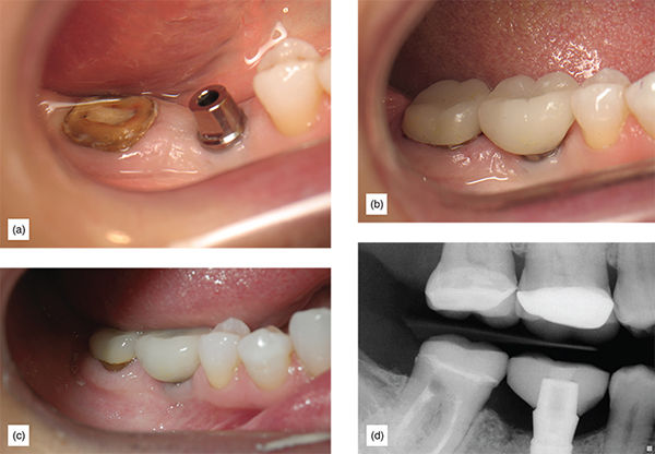 The Supragingival Protocol And Indications: Preventing Subgingival ...