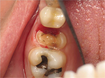 The Supragingival Protocol And Indications: Preventing Subgingival ...