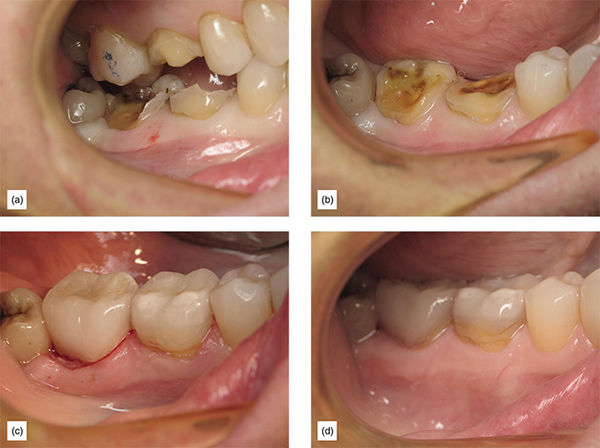 The Supragingival Protocol And Indications: Preventing Subgingival ...