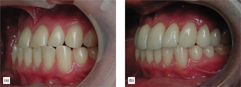 Supragingival Minimally Invasive Bonded Onlays: The Replacement For ...