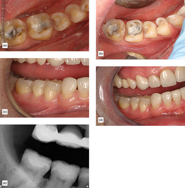 Supragingival Minimally Invasive Bonded Onlays: The Replacement For ...