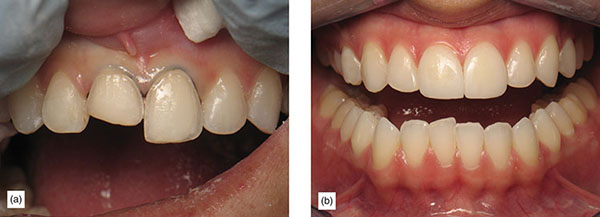 Indication, Preparation And Restorative Material For Supragingival ...