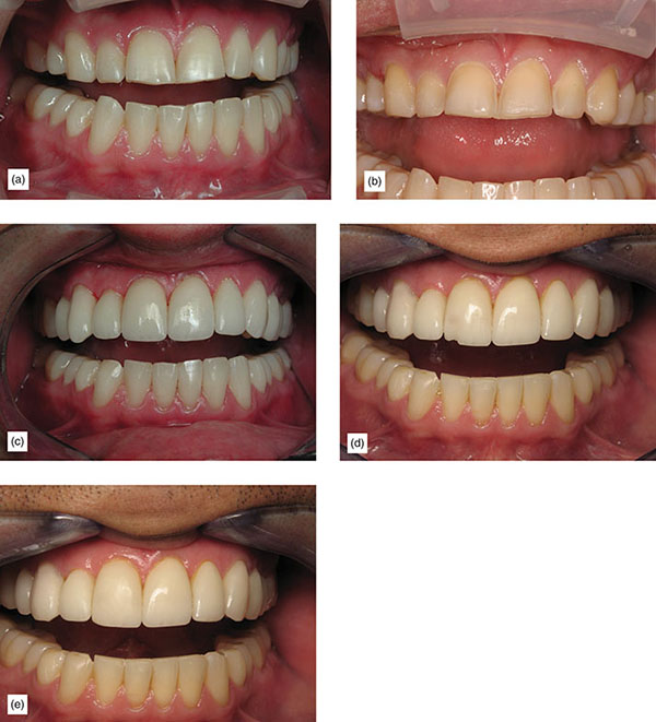 Indication, Preparation And Restorative Material For Supragingival ...