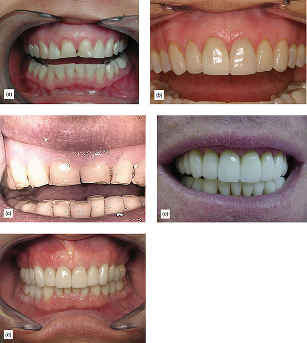 Indication, Preparation And Restorative Material For Supragingival ...