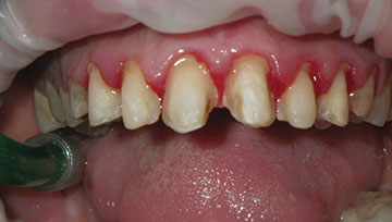 Indication, Preparation And Restorative Material For Supragingival ...