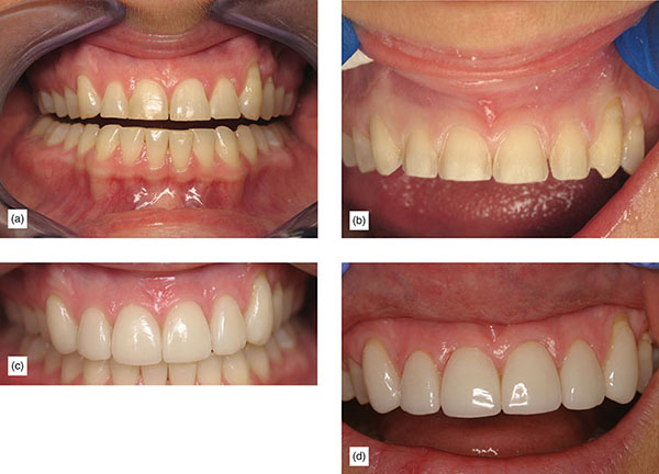 Indication, Preparation And Restorative Material For Supragingival ...