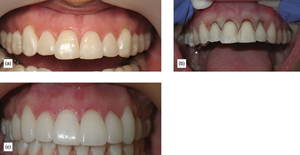 Indication, Preparation And Restorative Material For Supragingival ...