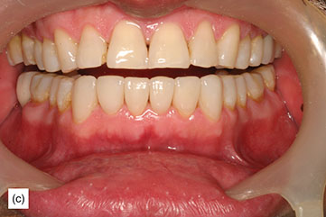 Indication, Preparation And Restorative Material For Supragingival ...