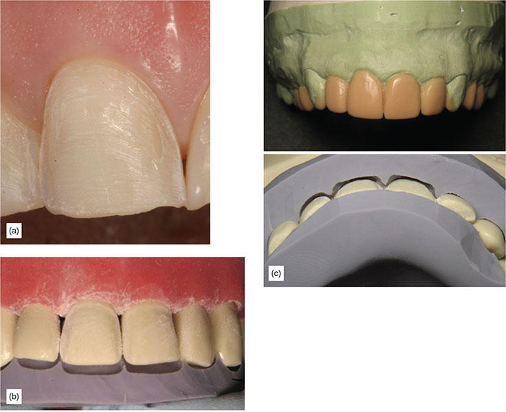 Indication, Preparation And Restorative Material For Supragingival ...