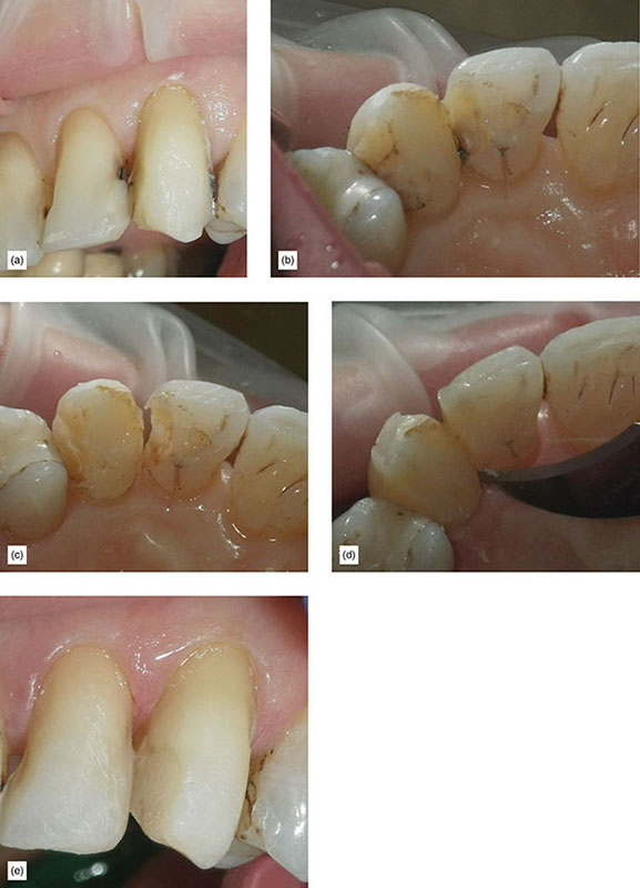 Indication, Preparation And Restorative Material For Supragingival ...