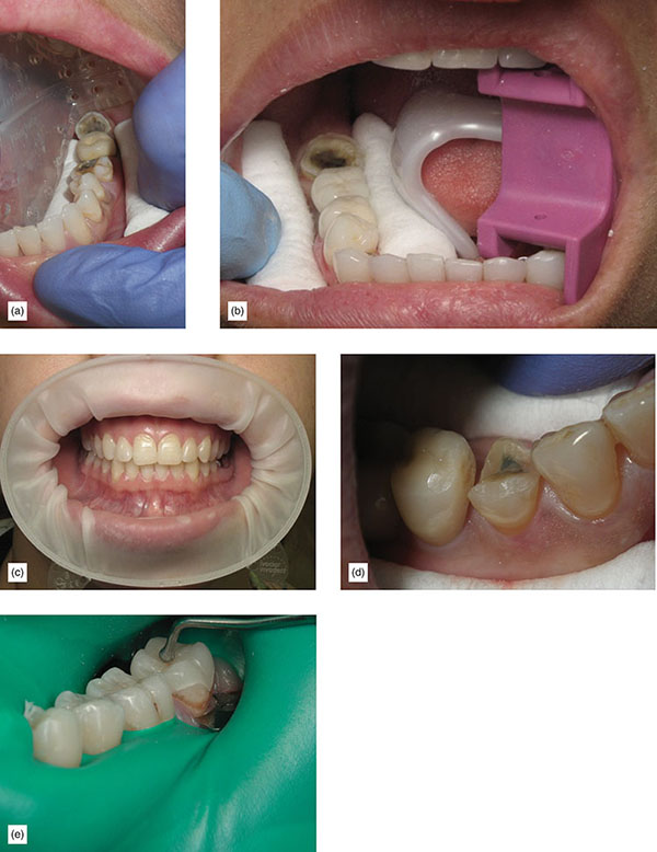 Bonded Cementation Of Veneers And Onlays | Pocket Dentistry