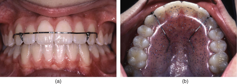 Retention And Post-retention Outcome | Pocket Dentistry