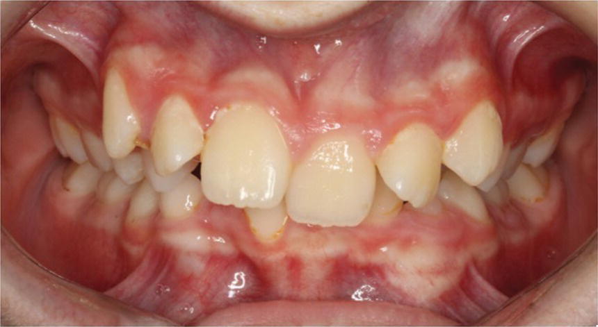 Treatment For Class I Malocclusion | Pocket Dentistry