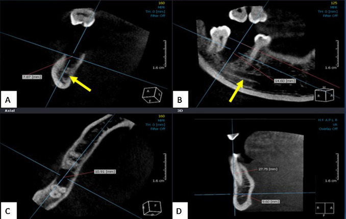 Simultaneous Implant Placement With Ridge Augmentation Using An