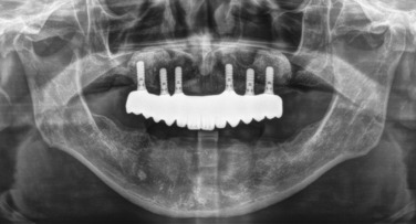Simultaneous Implant Placement With Ridge Augmentation Using Bone Ring