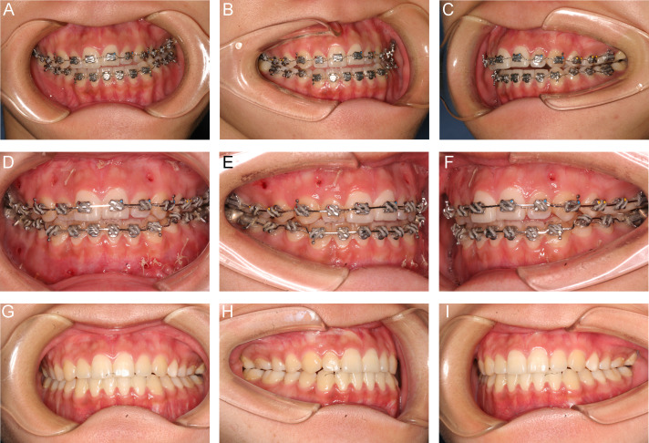 The Surgery-first Approach In Orthognathic Surgery: A Retrospective ...