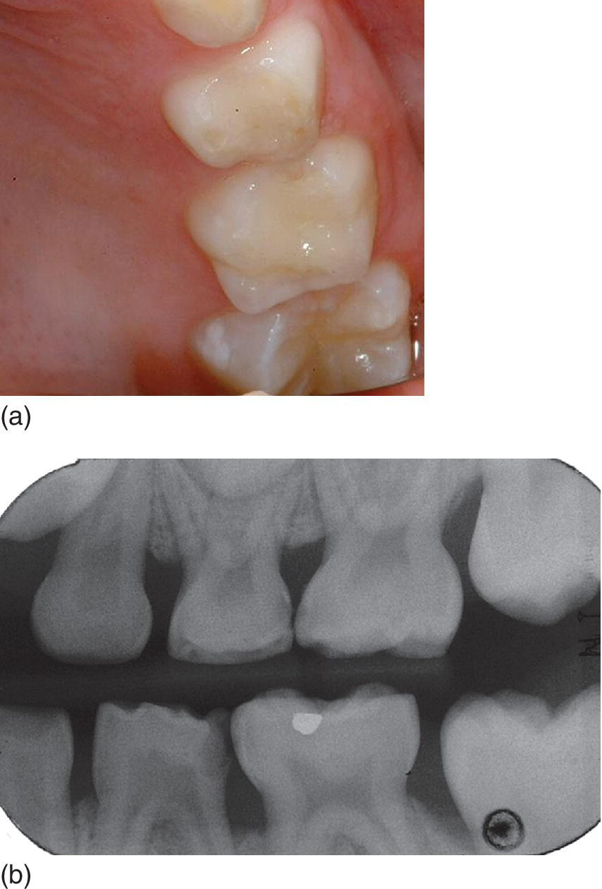 Procedures In Paediatric Dentistry | Pocket Dentistry