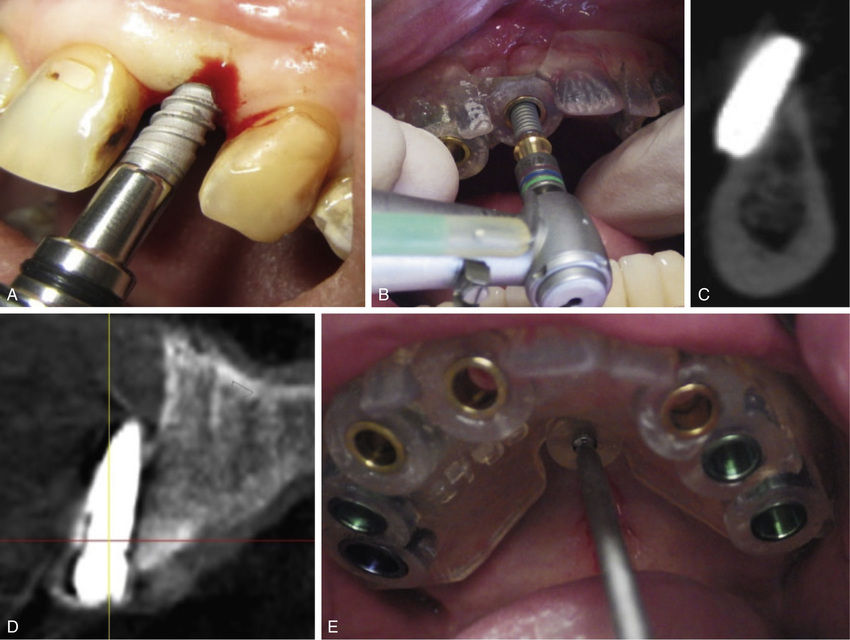 Dental Implant Intraoperative Complications | Pocket Dentistry