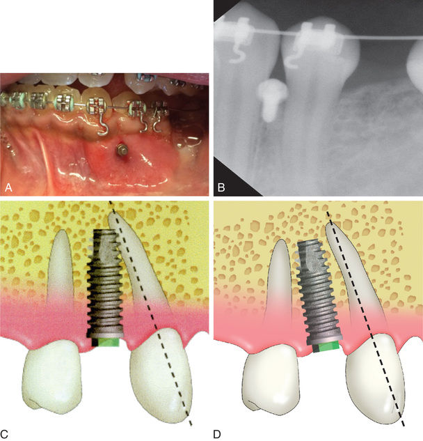 Ideal Implant Positioning | Pocket Dentistry