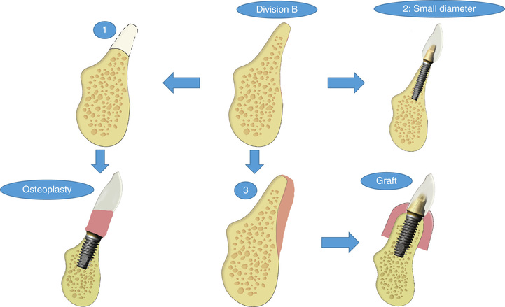 Bone Grafting Complications | Pocket Dentistry