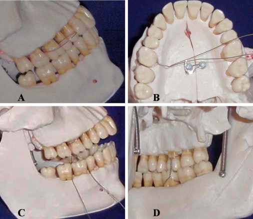 A Novel Versatile Technique For Achieving Buccolingual Intermaxillary ...