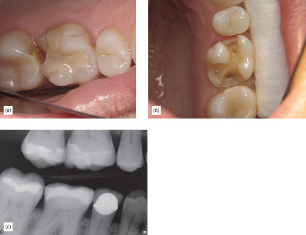 The Healthier Paradigm: Supragingival Minimally Invasive Adhesive ...