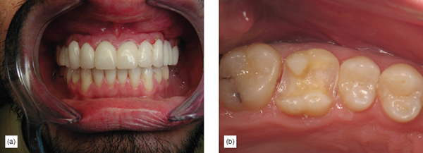 The Healthier Paradigm: Supragingival Minimally Invasive Adhesive ...