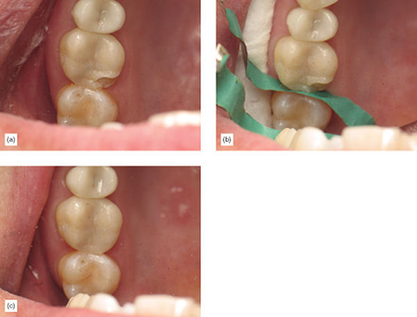 The Healthier Paradigm: Supragingival Minimally Invasive Adhesive ...