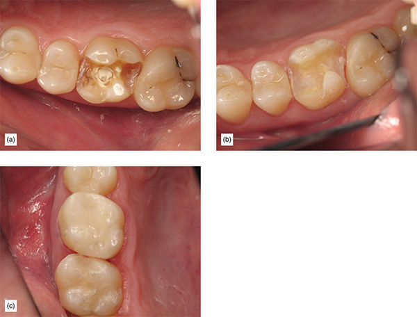 Supragingival Minimally Invasive Bonded Onlays: The Replacement For ...