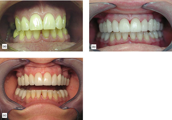 Indication, Preparation And Restorative Material For Supragingival ...