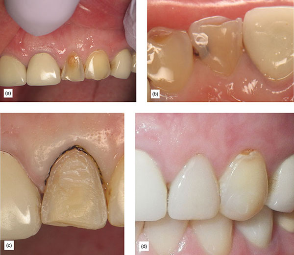 Indication, Preparation And Restorative Material For Supragingival ...