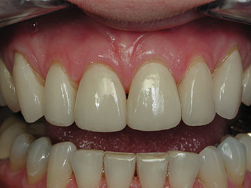 Indication, Preparation And Restorative Material For Supragingival ...