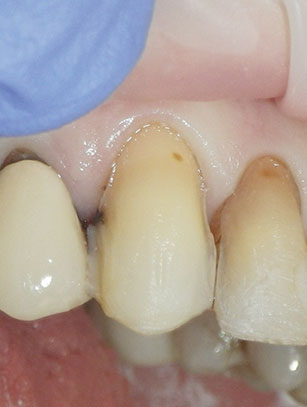 Indication, Preparation And Restorative Material For Supragingival ...