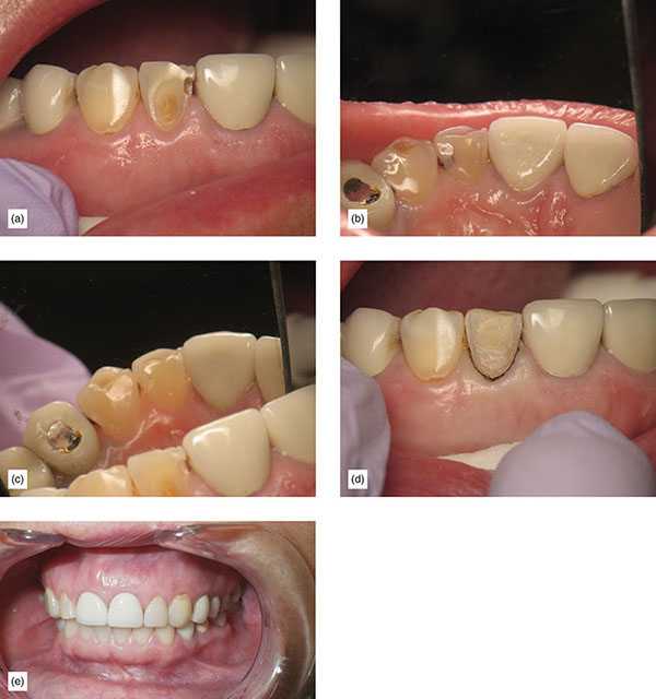 Indication, Preparation And Restorative Material For Supragingival ...