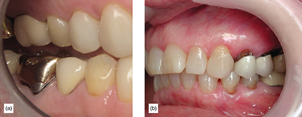 The Importance Of Occlusion And Occlusal Diagnosis In Restorative ...