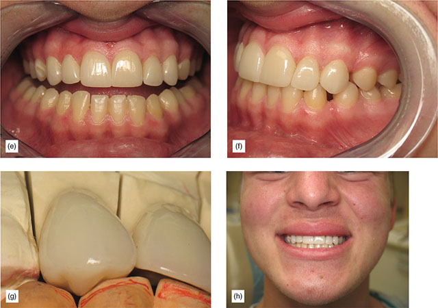 The Importance Of Occlusion And Occlusal Diagnosis In Restorative ...