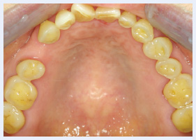 Grinding And Clenching Bruxism Pocket Dentistry