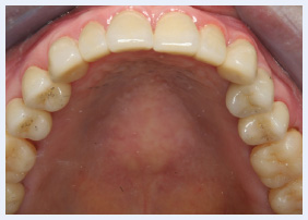 Grinding And Clenching Bruxism Pocket Dentistry