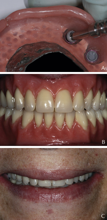 Implant Overdentures Retained By Self-aligning Stud-type Attachments: A ...