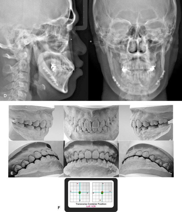 Orthognathic Surgery: An Update | Pocket Dentistry