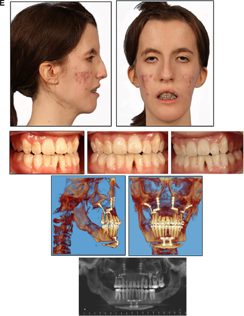 Use Of Distraction Osteogenesis In Orthognathic Surgery | Pocket Dentistry