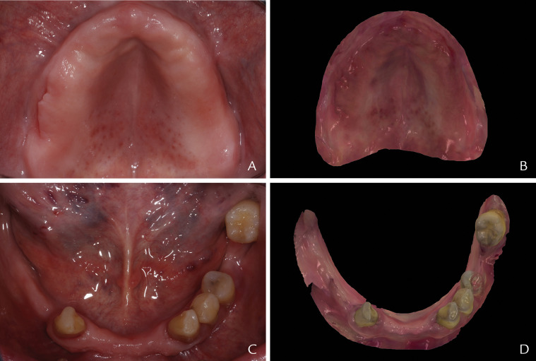 CAD-CAM Milled Dentures: The Geneva Protocols For Digital Dentures ...