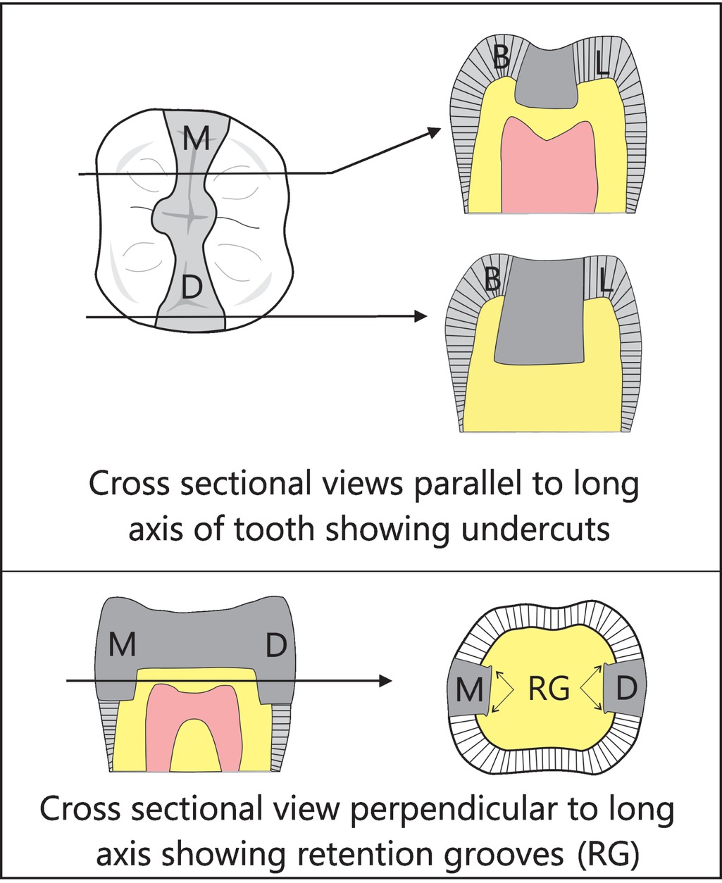 Amalgam | Pocket Dentistry