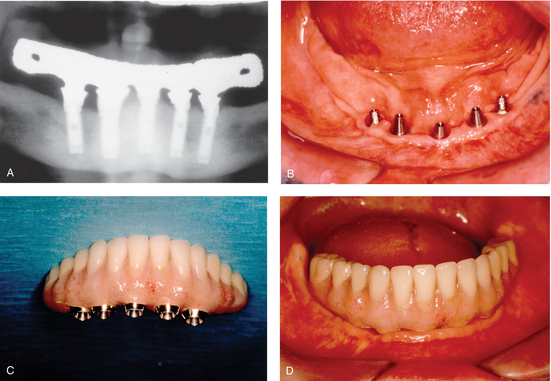 Dental Implants | Pocket Dentistry