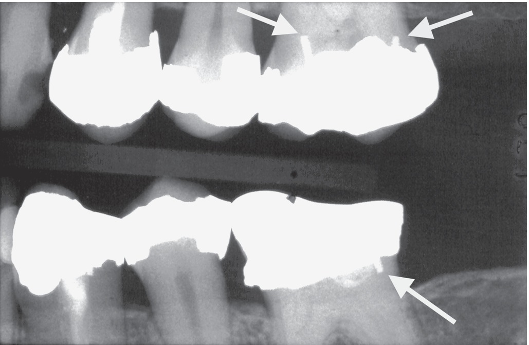 Radiographic Appearance Of Dental Tissues And Materials | Pocket Dentistry