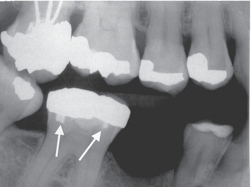 Radiographic Appearance Of Dental Tissues And Materials | Pocket Dentistry