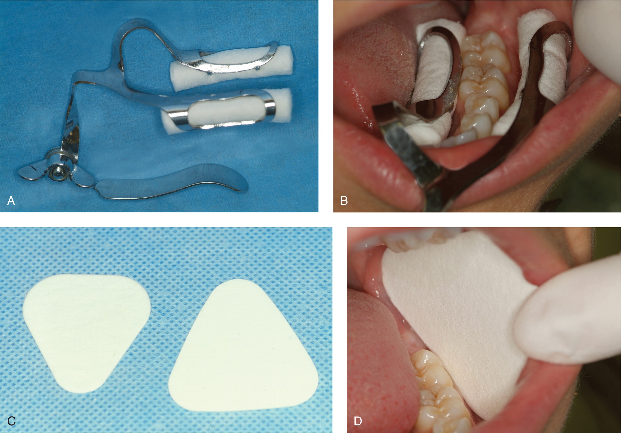 Pit And Fissure Sealants | Pocket Dentistry