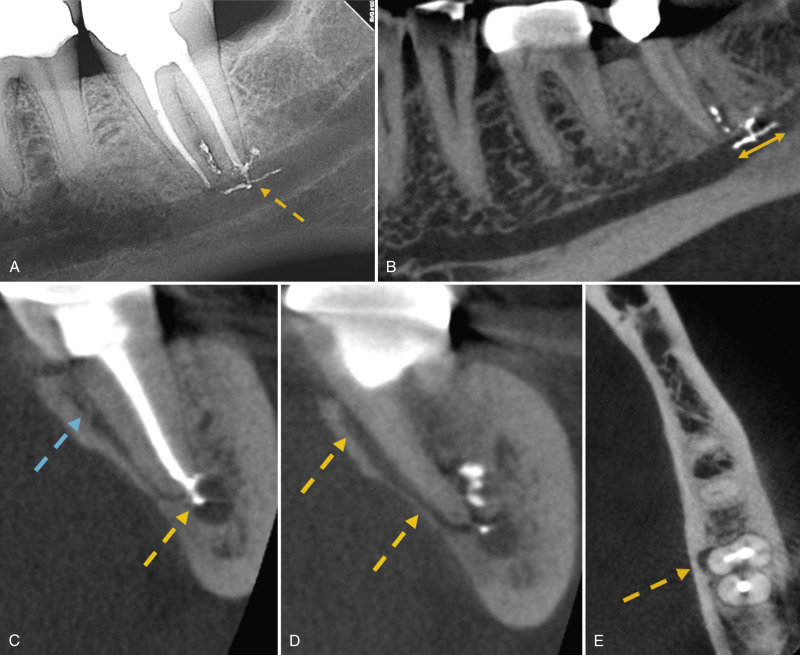 Radiographic Interpretation | Pocket Dentistry