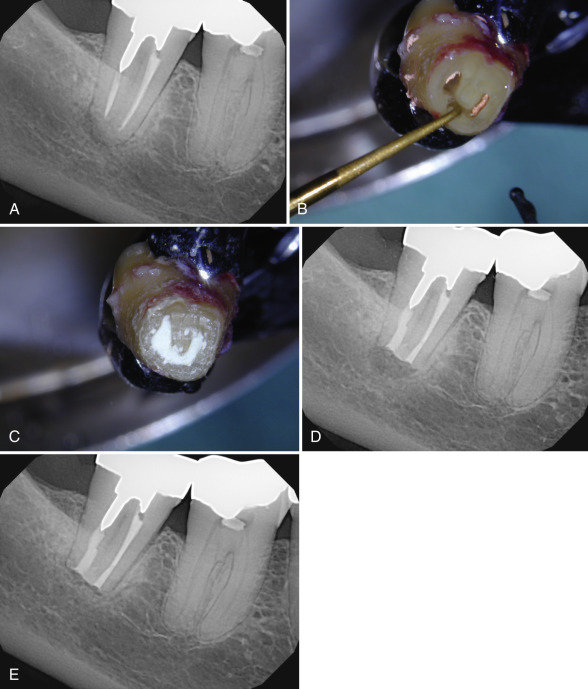 Nonsurgical Retreatment | Pocket Dentistry