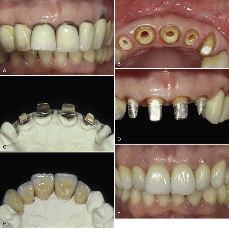 Restoration Of The Endodontically Treated Tooth | Pocket Dentistry